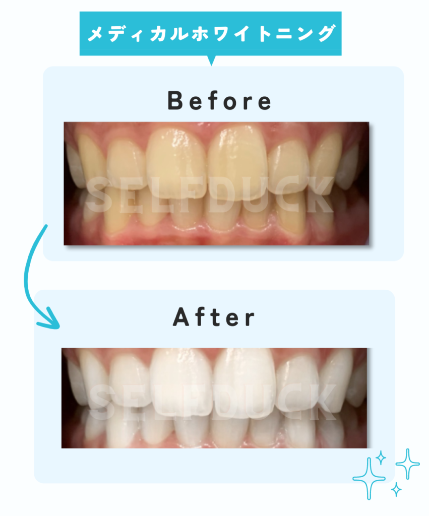 メディカルホワイトニング